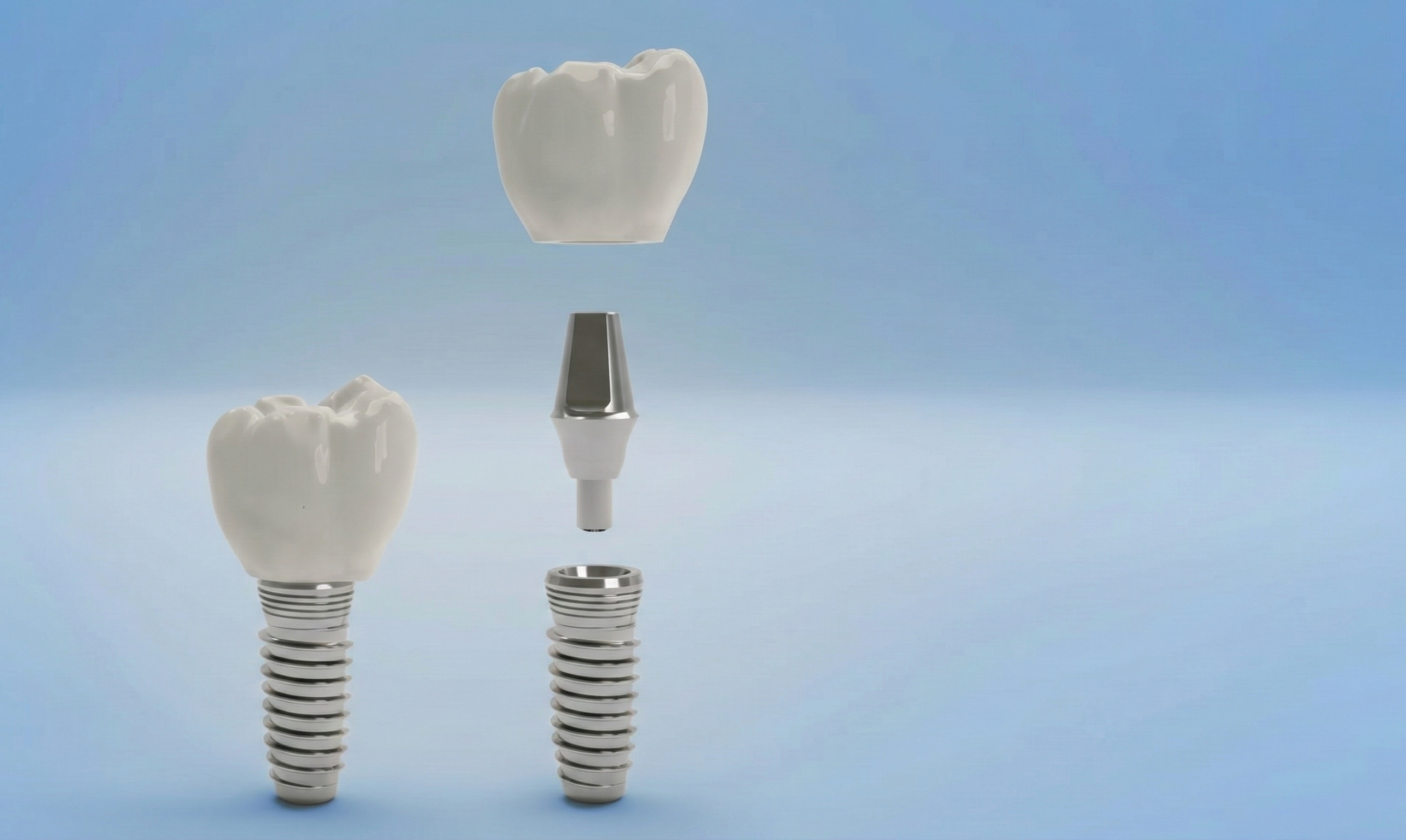 Diagram of a dental implant