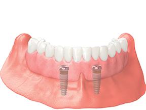 Diagram of a dental implant