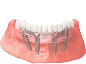 Diagram of a dental implant